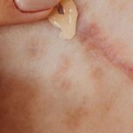 Fil résorbable qui ressort de la cicatrice