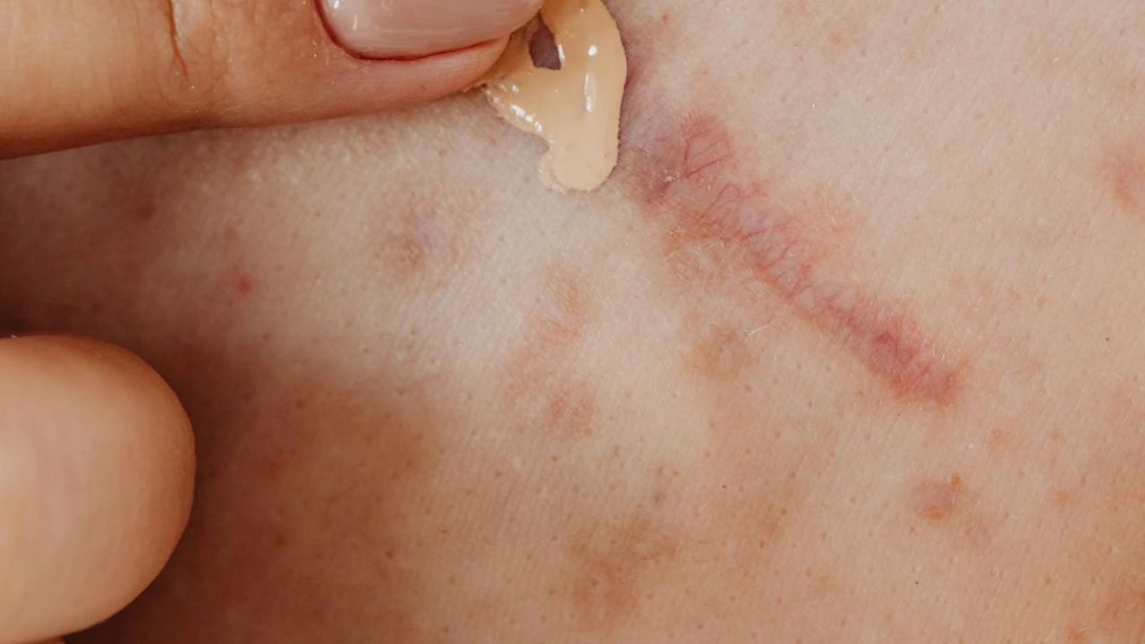 Fil résorbable qui ressort de la cicatrice