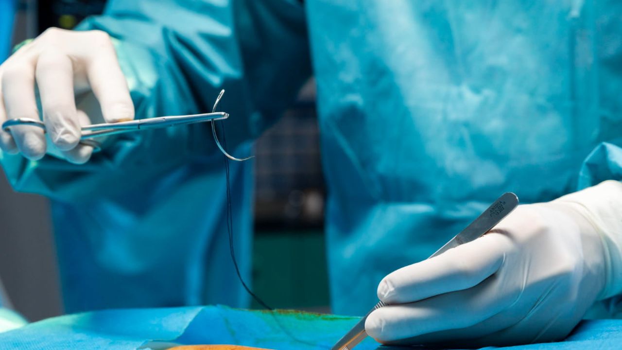 Cicatrice de circoncision avec bourrelet