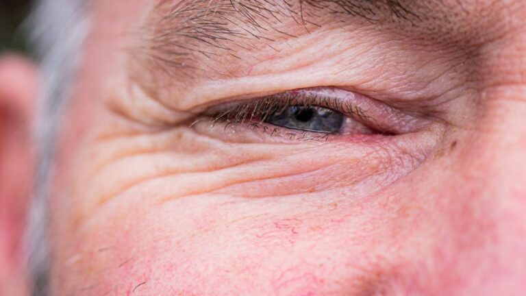 Je regrette ma blépharoplastie